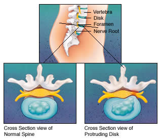 Sciatica